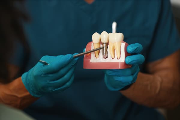 dental implant procedure on model
